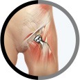 Hip Joint Replacement  surgery in Sharjah and Dubai