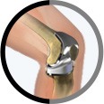 Knee Joint replacement surgery in Sharjah and Dubai