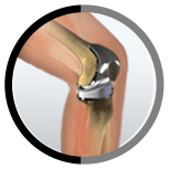 Total knee replacement in Sharjah and Dubai