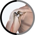 Shoulder Joint Replacement  surgery in Sharjah and Dubai